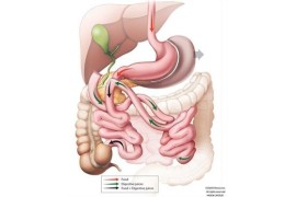 The Laparoscopic Duodenal Switch performed